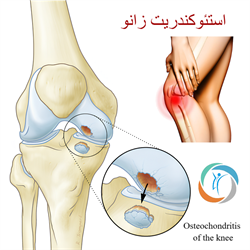 استئوکندریت زانو