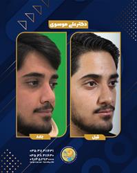 اهمیت زیبایی عمل بینی در آقایان