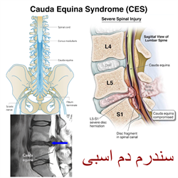 سندرم دم اسبی