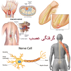 گرفتگی عصب