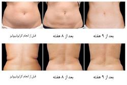چربی های شکمی چرا آب نمی شوند؟