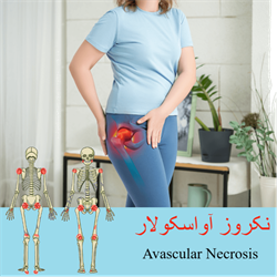 نکروز آواسکولار
