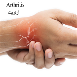 آرتریت