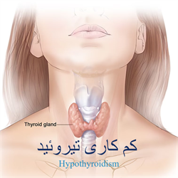 کم کاری تیروئید