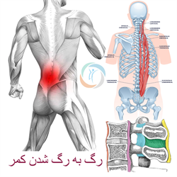 رگ به رگ شدن کمر