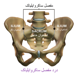 درد مفصل ساکروایلیاک