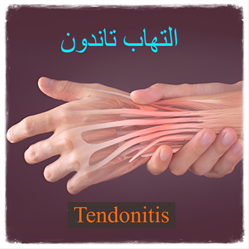 التهاب تاندون