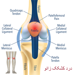 درد کشکک زانو