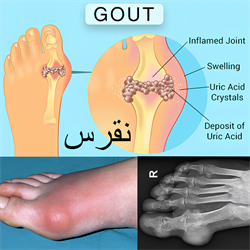 نقرس