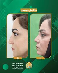 عمل زیبایی بینی (رینوپلاستی)