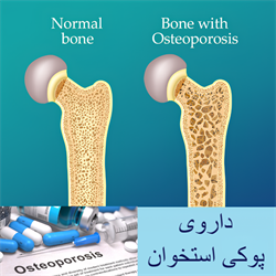 داروی پوکی استخوان