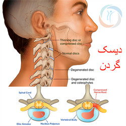 دیسک گردن