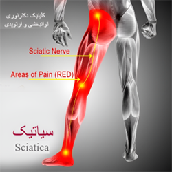 سیاتیک