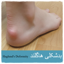بدشکلی هاگلند